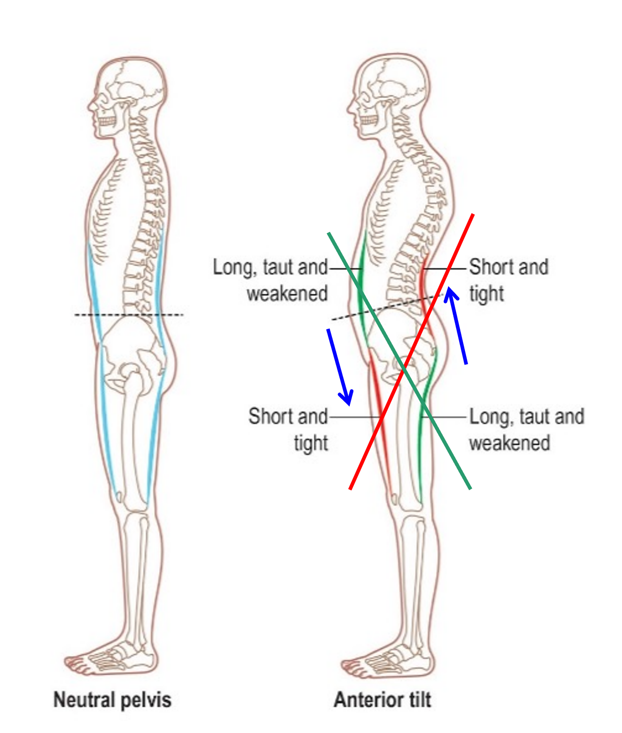 분당 자세교정 라룬리픽스에서의 바른자세와 잘 못된 자세의 예제