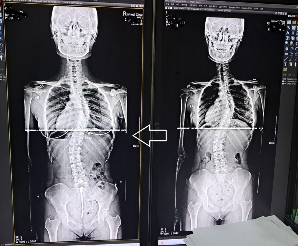 분당 허리 통증 척추측만 상담 사례