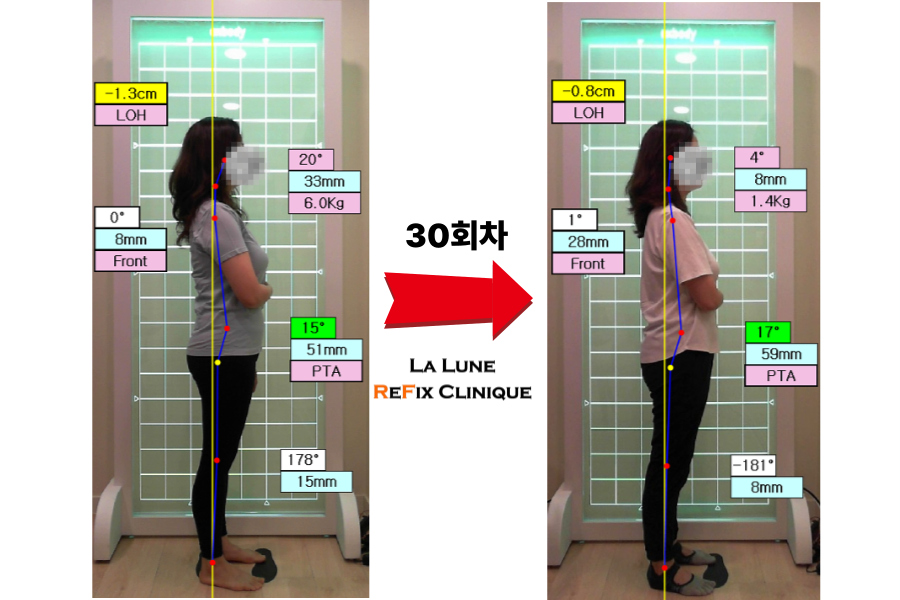 김O희님- 전후비교 30회차.png
